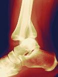 Fractured Ankle, X-ray-Miriam Maslo-Photographic Print
