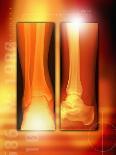 Healing Ankle Fracture, X-ray-Miriam Maslo-Framed Photographic Print