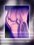 Healing Ankle Fracture, X-ray-Miriam Maslo-Photographic Print