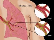 Bronchitis-Monica Schroeder-Framed Stretched Canvas