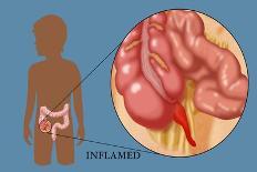 Inflamed Appendix-Monica Schroeder-Giclee Print