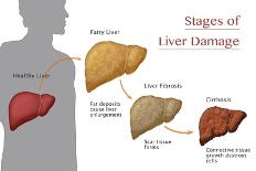 Stages of Liver Damage-Monica Schroeder-Giclee Print