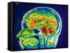 MRI Scan of Brain-null-Framed Stretched Canvas