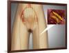 Narrowed Artery Near Leg with Microscopic Close-Up-null-Framed Art Print