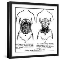 Nature Versus Corsets, 1903-null-Framed Giclee Print