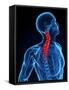 Neck Pain, Conceptual Artwork-SCIEPRO-Framed Stretched Canvas