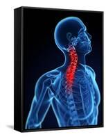 Neck Pain, Conceptual Artwork-SCIEPRO-Framed Stretched Canvas