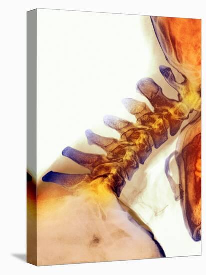 Neck Vertebrae Extended, X-ray-Science Photo Library-Stretched Canvas