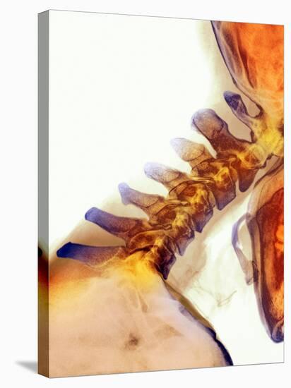 Neck Vertebrae Extended, X-ray-Science Photo Library-Stretched Canvas