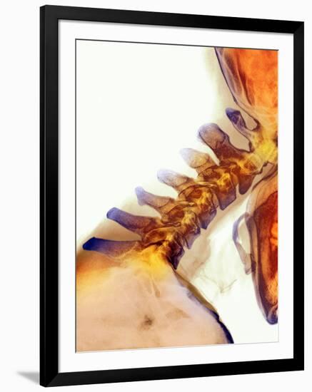 Neck Vertebrae Extended, X-ray-Science Photo Library-Framed Premium Photographic Print