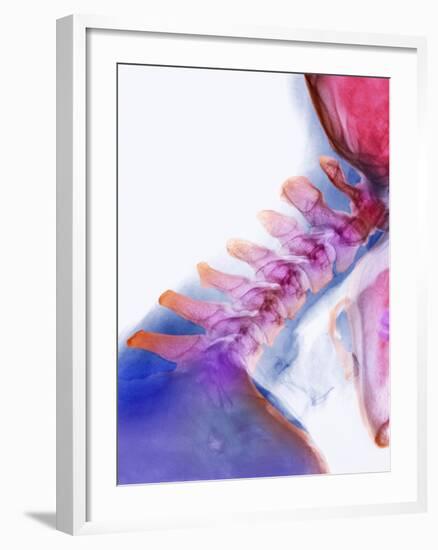 Neck Vertebrae Extended, X-ray-Science Photo Library-Framed Photographic Print