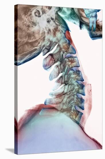 Neck Vertebrae Flexed, X-ray-Science Photo Library-Stretched Canvas