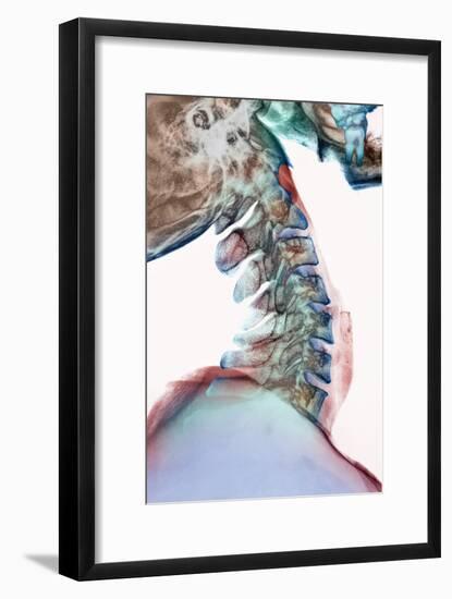 Neck Vertebrae Flexed, X-ray-Science Photo Library-Framed Photographic Print