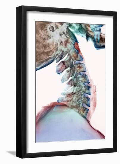 Neck Vertebrae Flexed, X-ray-Science Photo Library-Framed Photographic Print