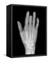 Needle Stuck In Hand, X-ray-Du Cane Medical-Framed Stretched Canvas