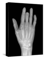 Needle Stuck In Hand, X-ray-Du Cane Medical-Stretched Canvas