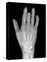 Needle Stuck In Hand, X-ray-Du Cane Medical-Stretched Canvas
