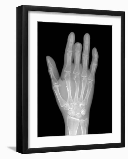 Needle Stuck In Hand, X-ray-Du Cane Medical-Framed Photographic Print