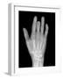 Needle Stuck In Hand, X-ray-Du Cane Medical-Framed Photographic Print