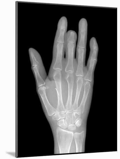 Needle Stuck In Hand, X-ray-Du Cane Medical-Mounted Photographic Print