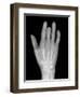 Needle Stuck In Hand, X-ray-Du Cane Medical-Framed Photographic Print