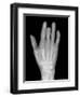 Needle Stuck In Hand, X-ray-Du Cane Medical-Framed Photographic Print