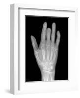 Needle Stuck In Hand, X-ray-Du Cane Medical-Framed Photographic Print