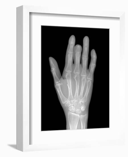 Needle Stuck In Hand, X-ray-Du Cane Medical-Framed Photographic Print