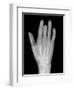 Needle Stuck In Hand, X-ray-Du Cane Medical-Framed Photographic Print