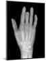 Needle Stuck In Hand, X-ray-Du Cane Medical-Mounted Photographic Print