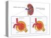 Normal and Diabetes-Damaged Kidneys, Illustration-Monica Schroeder-Stretched Canvas