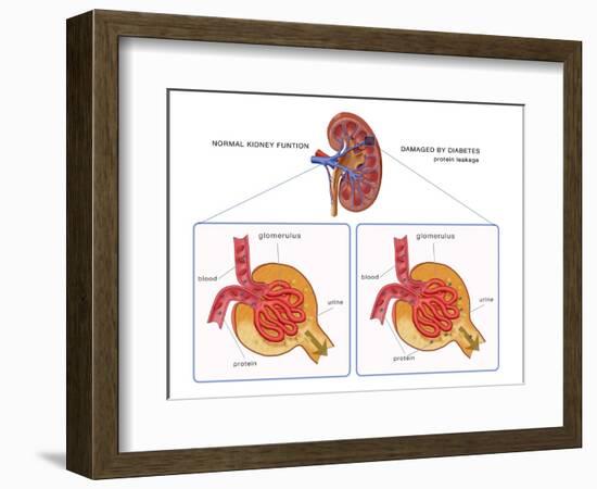 Normal and Diabetes-Damaged Kidneys, Illustration-Monica Schroeder-Framed Giclee Print