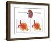 Normal and Diabetes-Damaged Kidneys, Illustration-Monica Schroeder-Framed Giclee Print
