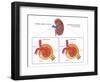 Normal and Diabetes-Damaged Kidneys, Illustration-Monica Schroeder-Framed Giclee Print