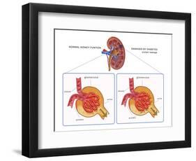 Normal and Diabetes-Damaged Kidneys, Illustration-Monica Schroeder-Framed Giclee Print