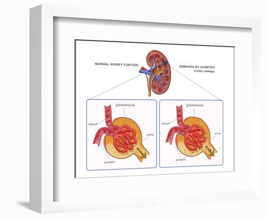 Normal and Diabetes-Damaged Kidneys, Illustration-Monica Schroeder-Framed Giclee Print