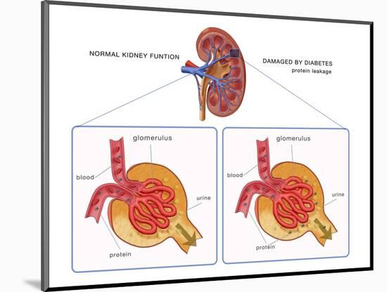 Normal and Diabetes-Damaged Kidneys, Illustration-Monica Schroeder-Mounted Giclee Print