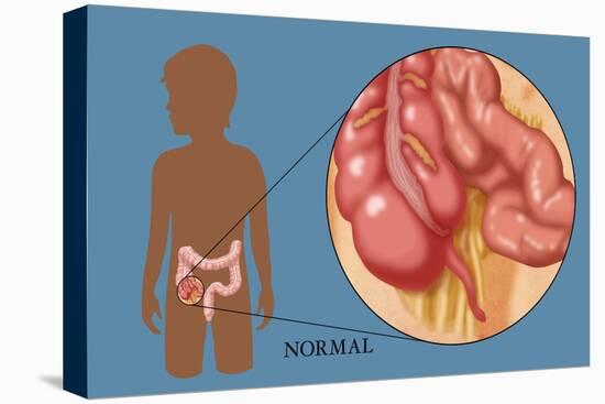 Normal Appendix-Monica Schroeder-Stretched Canvas