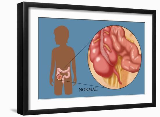 Normal Appendix-Monica Schroeder-Framed Giclee Print