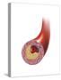 Normal Artery Compared to Plaque and Thrombus Formation in Artery-null-Stretched Canvas