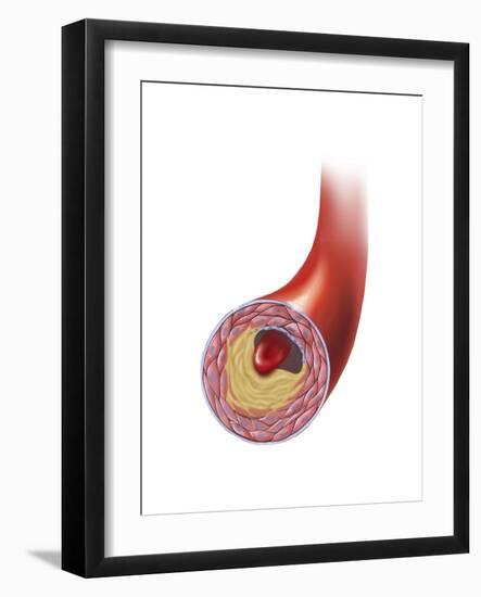 Normal Artery Compared to Plaque and Thrombus Formation in Artery-null-Framed Art Print