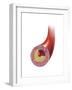 Normal Artery Compared to Plaque and Thrombus Formation in Artery-null-Framed Art Print