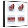 Normal Artery Compared to Plaque and Thrombus Formation in Artery-null-Framed Stretched Canvas