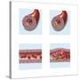 Normal Artery Compared to Plaque and Thrombus Formation in Artery-null-Stretched Canvas