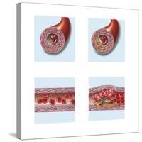 Normal Artery Compared to Plaque and Thrombus Formation in Artery-null-Stretched Canvas