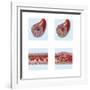 Normal Artery Compared to Plaque and Thrombus Formation in Artery-null-Framed Art Print