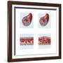 Normal Artery Compared to Plaque and Thrombus Formation in Artery-null-Framed Art Print