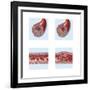 Normal Artery Compared to Plaque and Thrombus Formation in Artery-null-Framed Art Print