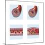 Normal Artery Compared to Plaque and Thrombus Formation in Artery-null-Mounted Art Print