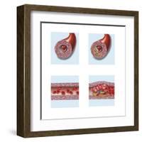 Normal Artery Compared to Plaque and Thrombus Formation in Artery-null-Framed Art Print